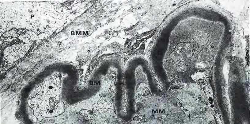 Elektronová mikroskopie Původ denzních depozit je nejasný. Nezdařilo se vytvořit proti depozitům protilátky. Jde tedy o materiál, který ztratil antigenicitu. Podle některých jde o glykoprotein.