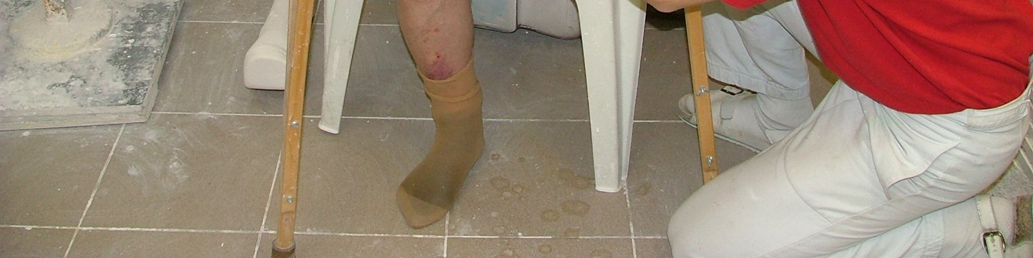5.3. Sejmutí negativu negativ snímáme po jeho úplném zatuhnutí a děláme to velice obezřetně tak, abychom jej nezdeformovali. Většinou stačí pokrčit sádrovanou končetinu a povolit svalový tonus.