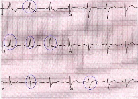 EKG očima záchranáře - PDF Free Download