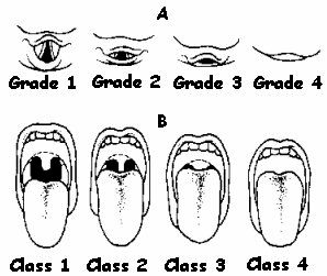 Příloha M Mallampatiho klasifikace Obr.