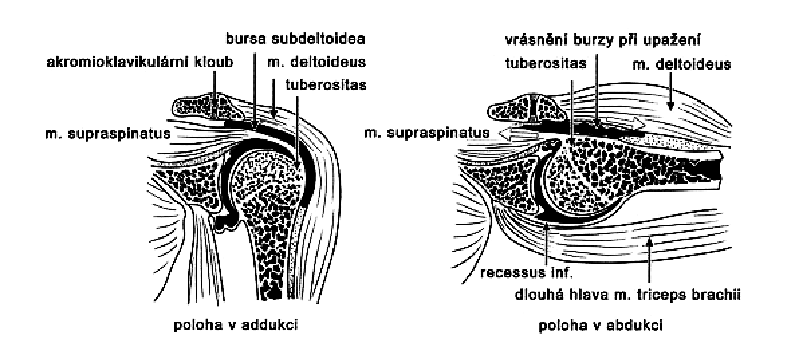 Obr. 5 - Stav pouzdra ramenního kloubu a okolních měkkých tkání v klidu a při upažení, kdy dochází k bolestivému oblouku (Velé, 2006). Důležitým pohybem je i tzv.