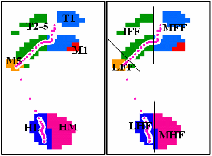 Hodnocení plantární distribuce tlaku Na základě vhodnosti k hodnocení hypotéz jsem plosku nohy rozdělila do šesti oblastí regions of interest (ROI): MFF medial forefoot mediální přednoží (M1+T1) IFF