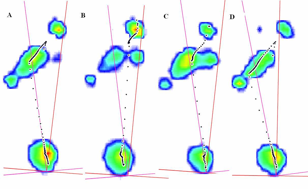 M.Z. - Celkové součty tlaků během stojné fáze chůze a průběh COP, typické snímky: A - bez ortézy, B - s funkční ortézou, C - s proprioceptivní ortézou, D - s návlekem. U subjektu M.Z. bylo kromě