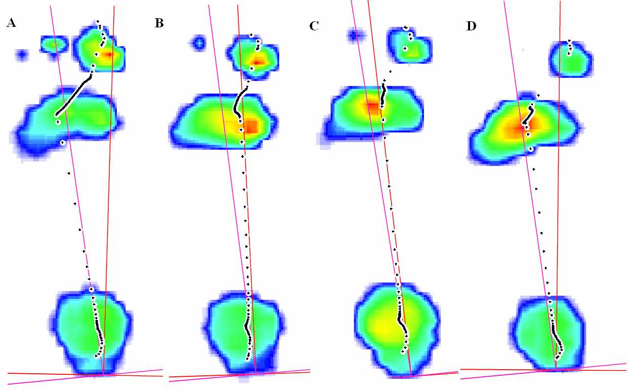 L.CH. - Celkové součty tlaků během stojné fáze chůze a průběh COP, typické snímky: A - bez ortézy, B - s funkční ortézou, C - s proprioceptivní ortézou, D - s návlekem Výsledky aspekčního hodnocení