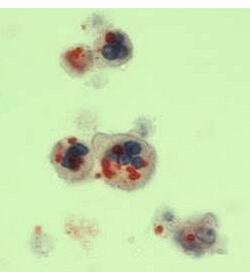Obsahem ložisek v CNS bývají: Borrelia FSME CMV EB Neisseria meningitidis Herpesvirus Toxoplasma gondii a
