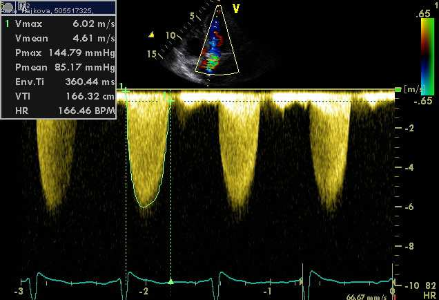 Aortální stenóza echokardiografie Morfologie chlopně (kalcifikace) Významnost stenózy doppler (gradienty, plocha