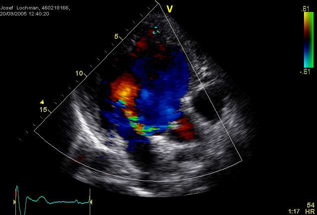 Aortální regurgitace echokardiografie Morfologie chlopně Významnost regurgitace doppler