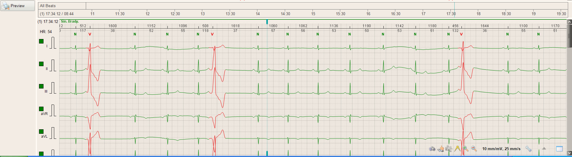 .6. Maximalizace zobrazení signálu Klikněte na ikonku () pro zvětšení EKG.6.3 přes celou obrazovku. Tato ikonka je dostupná ve všech oknech se signálem (EKG, Plné zobrazení, Dlaždice).