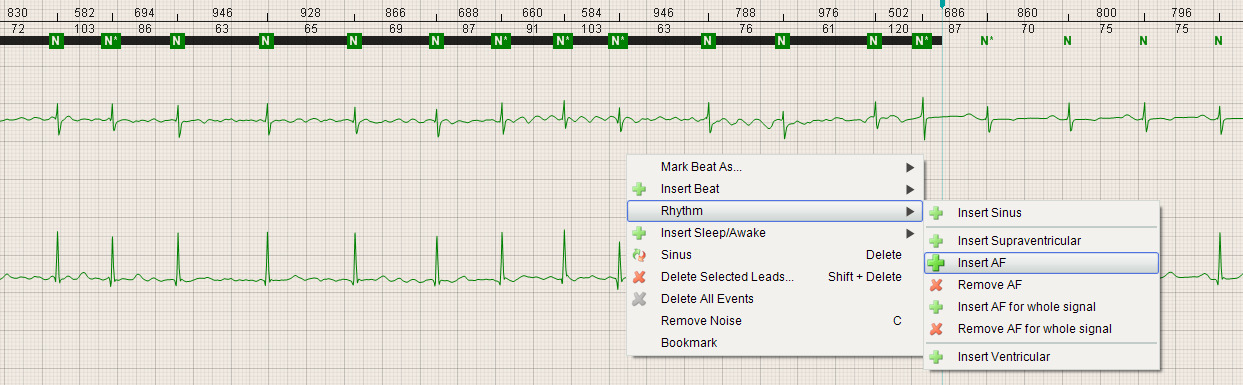 .6.6 Měření na EKG křivce 3 5 Klikněte na ikonku kružítka (). Dojde k zobrazení horizontálních a vertikálních linek a dodatečného menu.