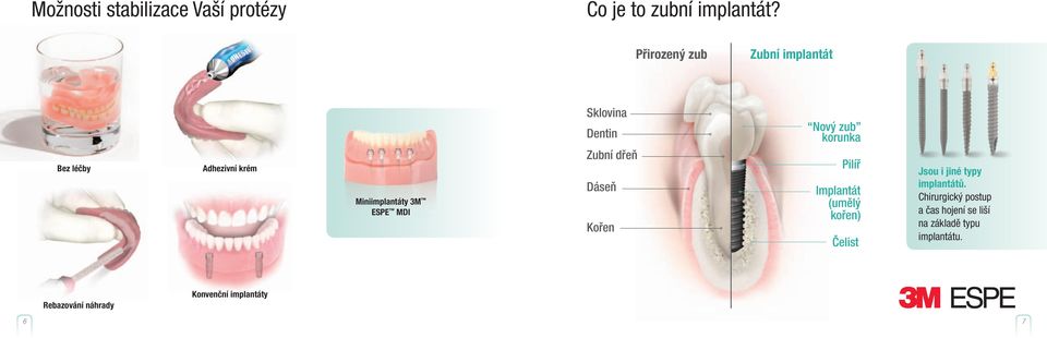 Dentin Zubní dřeň Dáseň Kořen Nový zub korunka Pilíř Implantát (umělý kořen) Čelist Jsou i