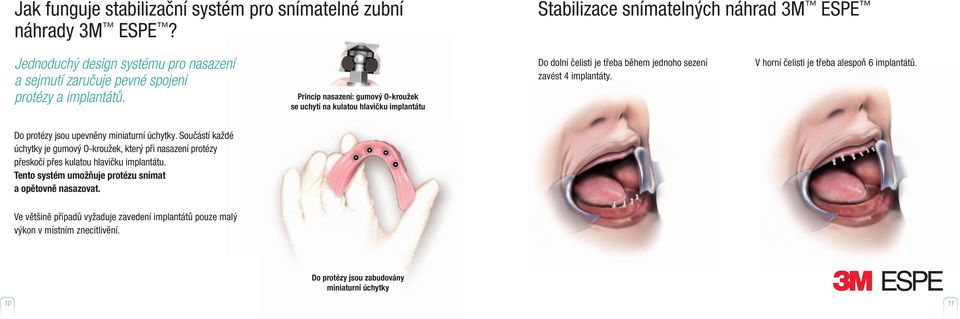 Princip nasazení: gumový O-kroužek se uchytí na kulatou hlavičku implantátu Do dolní čelisti je třeba během jednoho sezení zavést 4 implantáty.