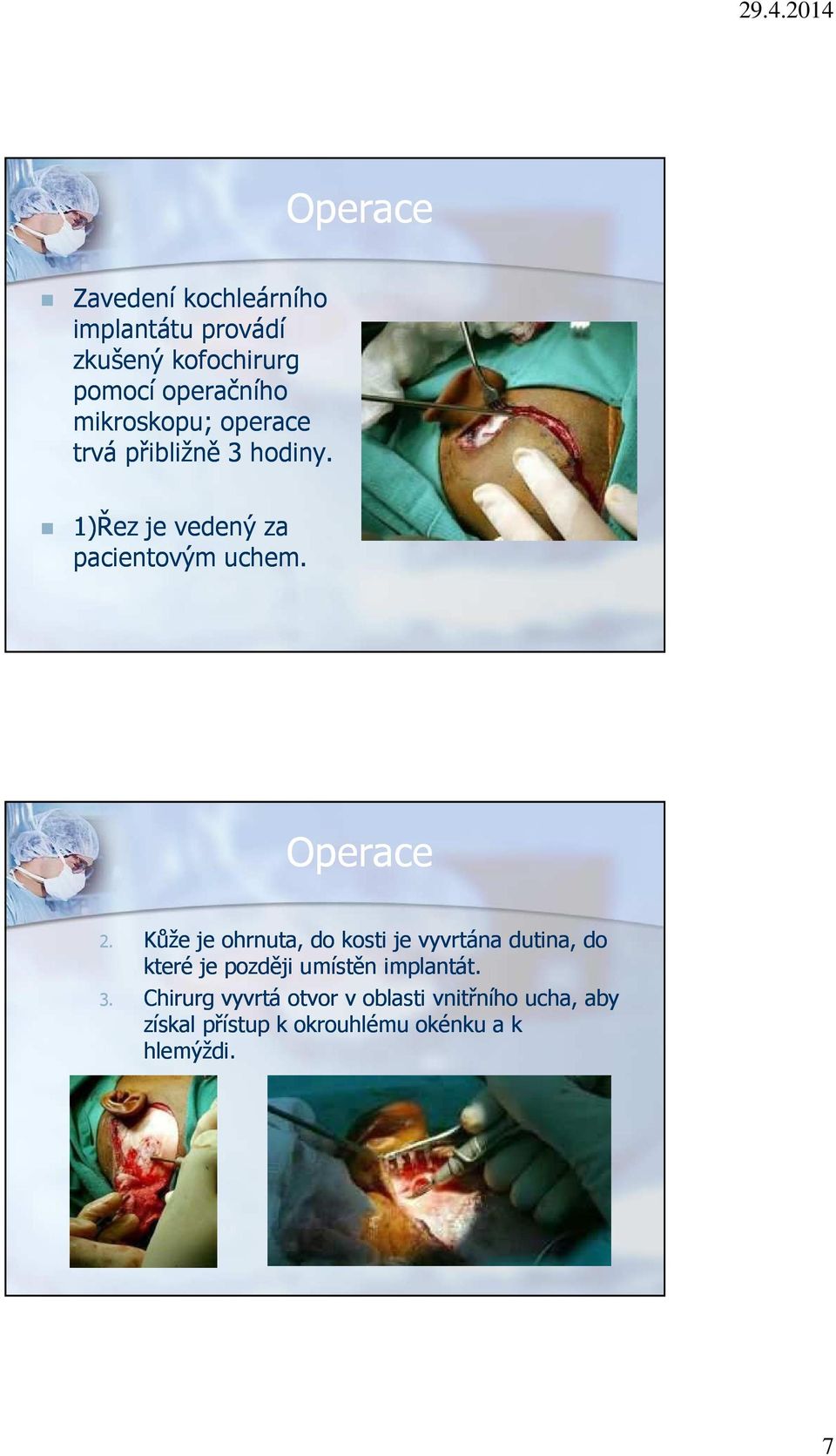 Kůže je ohrnuta, do kosti je vyvrtána dutina, do které je později umístěn implantát. 3.