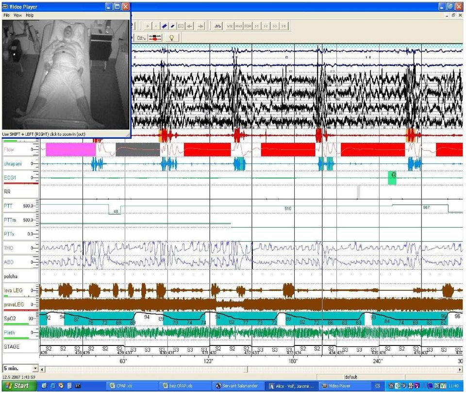 První dva řádky jsou záznam EOG, níže pak záznam EEG, kde pod ním zvýrazněné červené čáry označují mikroprobuzení, následující řádek průtoku