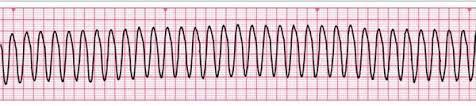 Ergometrie zajištění interpretace EKG, obtíží pacienta pomůcky