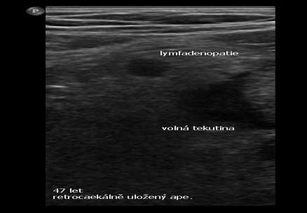 Další nálezy na UZ Zesílení stěny ileocaekálního přechodu, lokální lymfadenopatie Chronická apendicitida: mírné zesílení apendixu,
