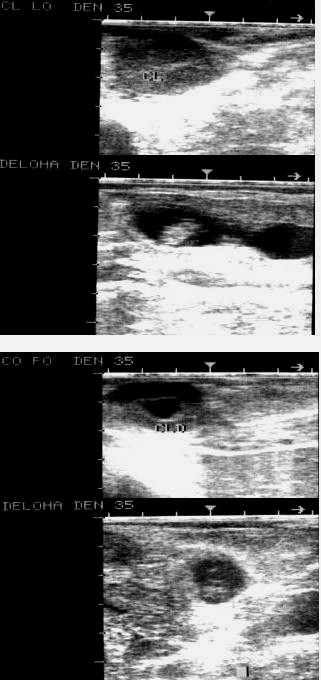 Obrázek 6: Děloha a CL na levém ovariu/