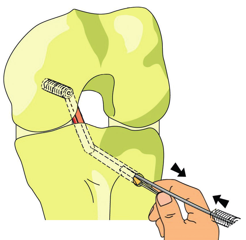 4. Ukotvení štěpu v tibii interferenčním šroubem Ukotvenou šlachu ve femuru pevně vypněte v 60 90 st.