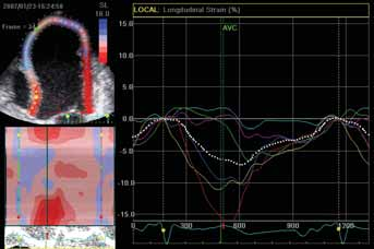A septum B apex lat. systola Obr. 1. Základní principy speckle tracking echokardiografie a její hodnocení. A.