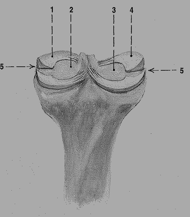 1.3.2 Menisky Obr. 3 Meniskus kolenního kloubu: pravá strana, pohled zezadu (Čihák, Anatomie I. 2001) 1. Meniscus medialis 2. Kloubní plocha na mediálním kondylu tibie 3.