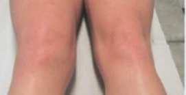 4. Klinický obraz poranění předního zkříženého vazu Obr. 9 Otok kolenního kloubu, srovnání s druhou stranou Při úrazu postižený cítí prudkou bolest, pocit prasknutí, lupnutí, či vyskočení kolene.