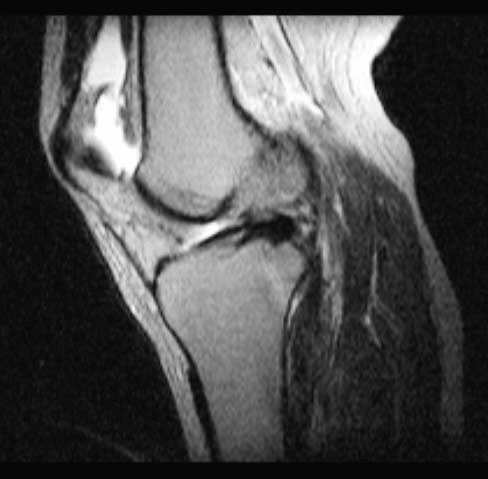 MR (magnetická rezonance) MR ozřejmí všechny struktury kolenního kloubu: kostěné, chrupavčité, měkké tkáně, ligamenta, menisky.