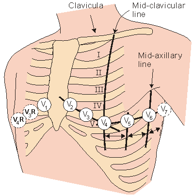Wilsonovy hrudní svody šestice hrudních elektrod proti centrální Wilsonově svorce svody V 1, V 2, V