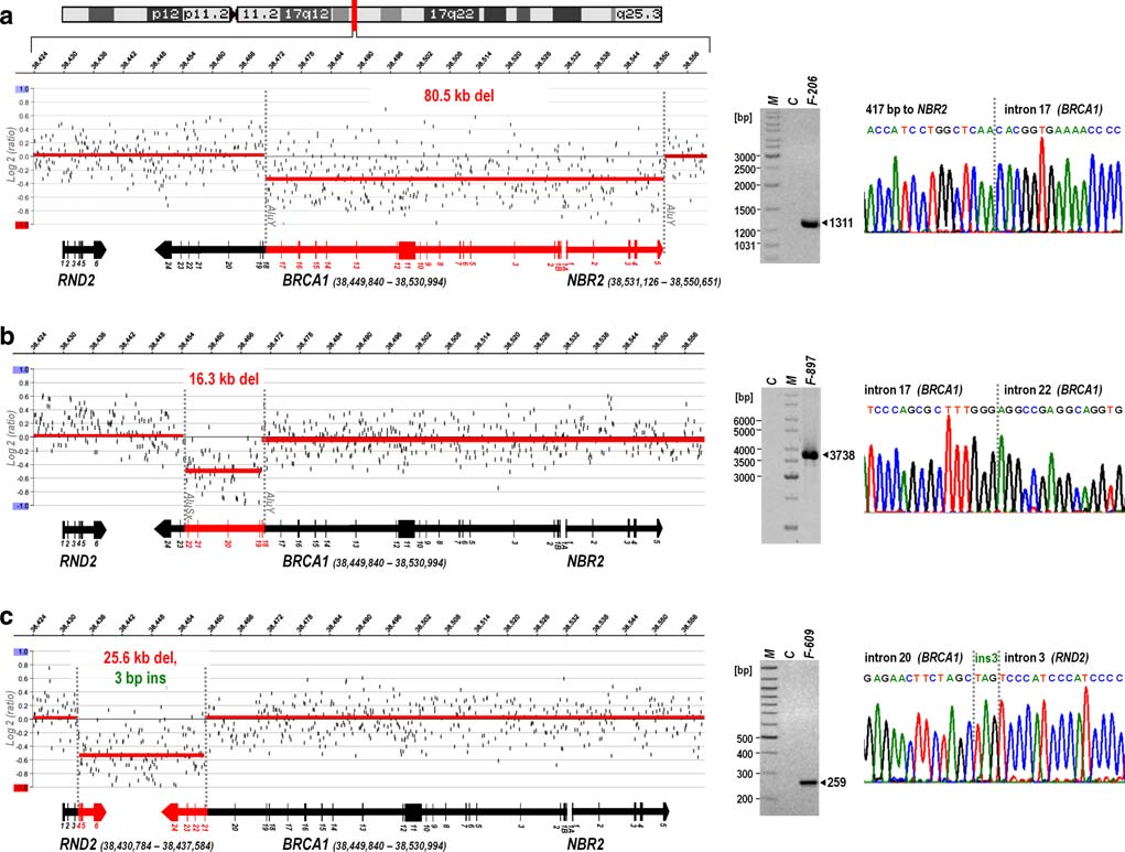 Breast Cancer Res Treat Fig. 2 Breakpoint analysis of three novel genomic rearrangements. Left copy number analysis at the BRCA1 locus by acgh.
