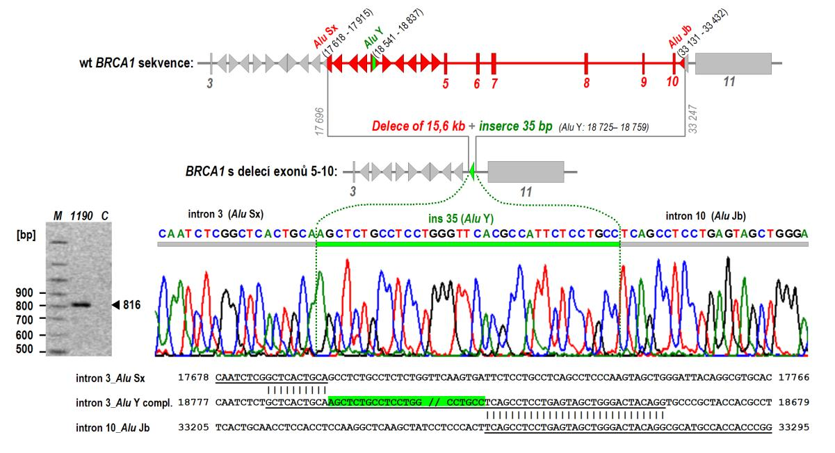 Obrázek 14: Charakterizace a určení bodů zlomu u komplexní genomové přestavby zahrnující deleci exonů 5-10 a inzerci 35 nukleotidů pomocí LR-PCR a sekvenování.