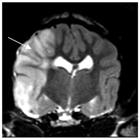 Infarkt v