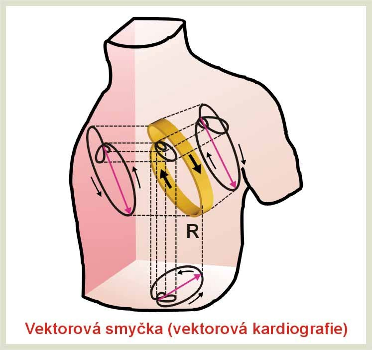 - 29 - Obrázek 18 Souvislost frontálního VKG s EKG napětími končetinových svodů Obrázek 19 Prostorová vektorová smyčka