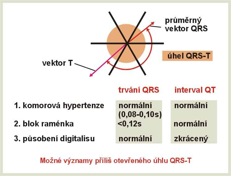- 39 - Obrázek 25 Orientace vektoru QRS charakterizující různé tvary a polohy srdce, resp.