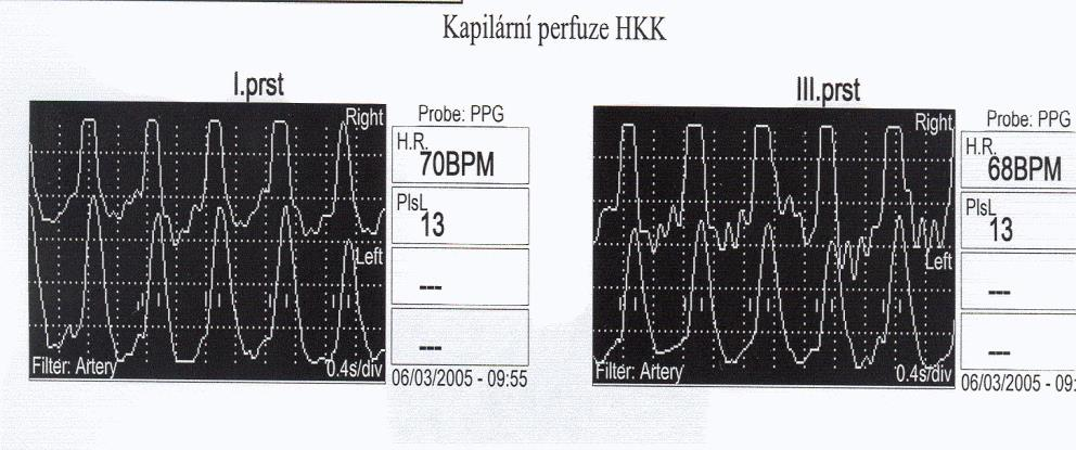 Periferní Doppler Kapilární perfuze Doppler: stenóza či okluze a.