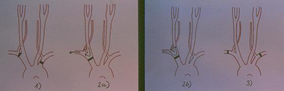 Subclavian steal syndrom - typy 1) Klasický subclavian steal 2a) Innominate steal carotid steal 2b)