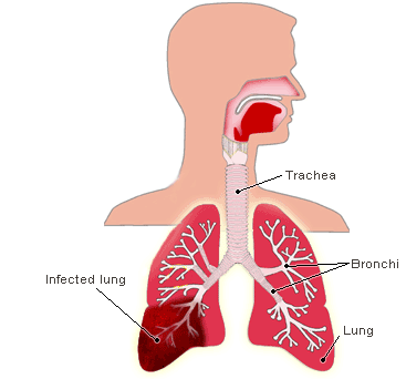 Definice Etiologie,bakteriologické a histologické