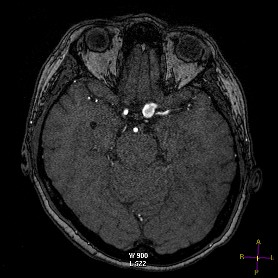 MR angiografie Nativní MRAG mozkové tepny