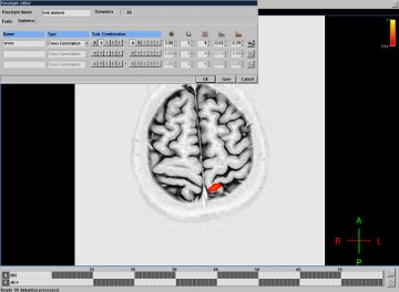 fmri vyšetření Vyšetření celého mozku mnohočetně opakováno Pacient během vyšetření vyzván k určitému druhu aktivity (pohyb prstů, řeč.
