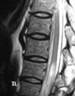 Syndrome of conus, epiconus: vertebral body level: Th12-L1 Conus (S3-5) often tumor, traumatic injury Altered perianogenital sensation Urinary retention, fecal