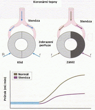 Obrázek 6 - Princip zátěžového vyšetření (Zdroj: http://vyuka.i-consult.cz/kardiologie/ghtml.php?id=34) 2.4.2 Radiofarmaka 201 Tl-thallium Jedná se o radionuklidy produkované v cyklotronu.