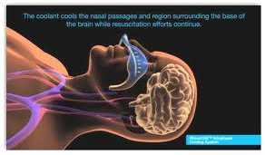 Transnasální ochlahování Intranasal cooling with the RhinoChill device appears safe and effectively lowers brain and core temperatures.