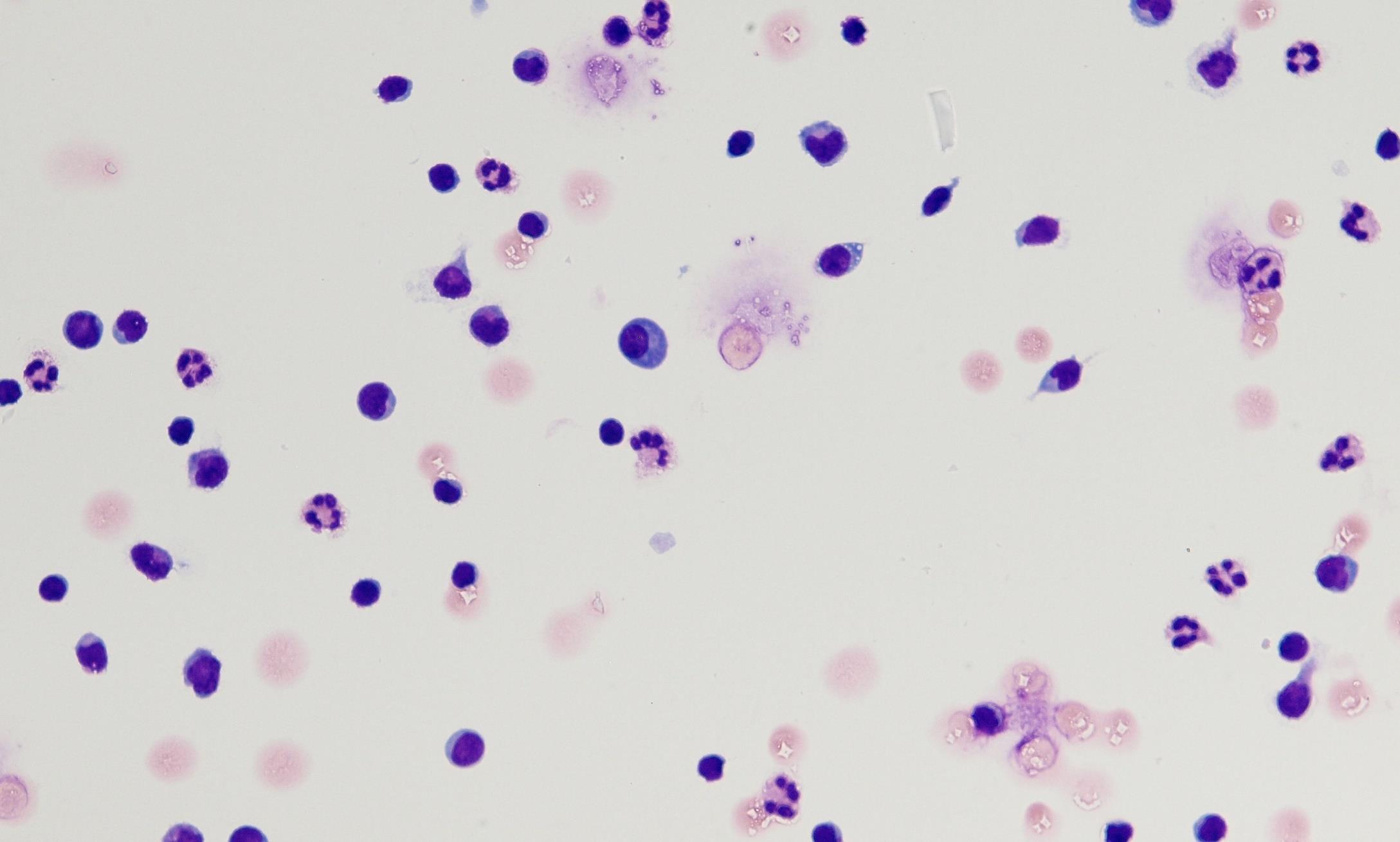 TBE- KME Klasický obraz virového zánětu: Střední pleocytoza (10/100-ky el/ul).