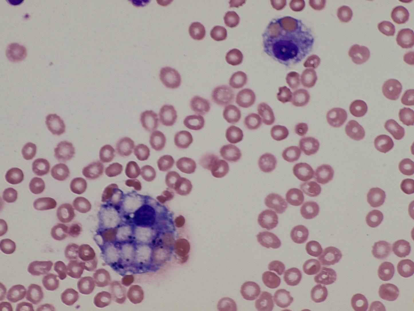 SAK ID 2469/2014: Elementy CSF: 267 /ul, Erytrocyty CSF: 26283 /ul Velká krevní příměs s podílem PMN.