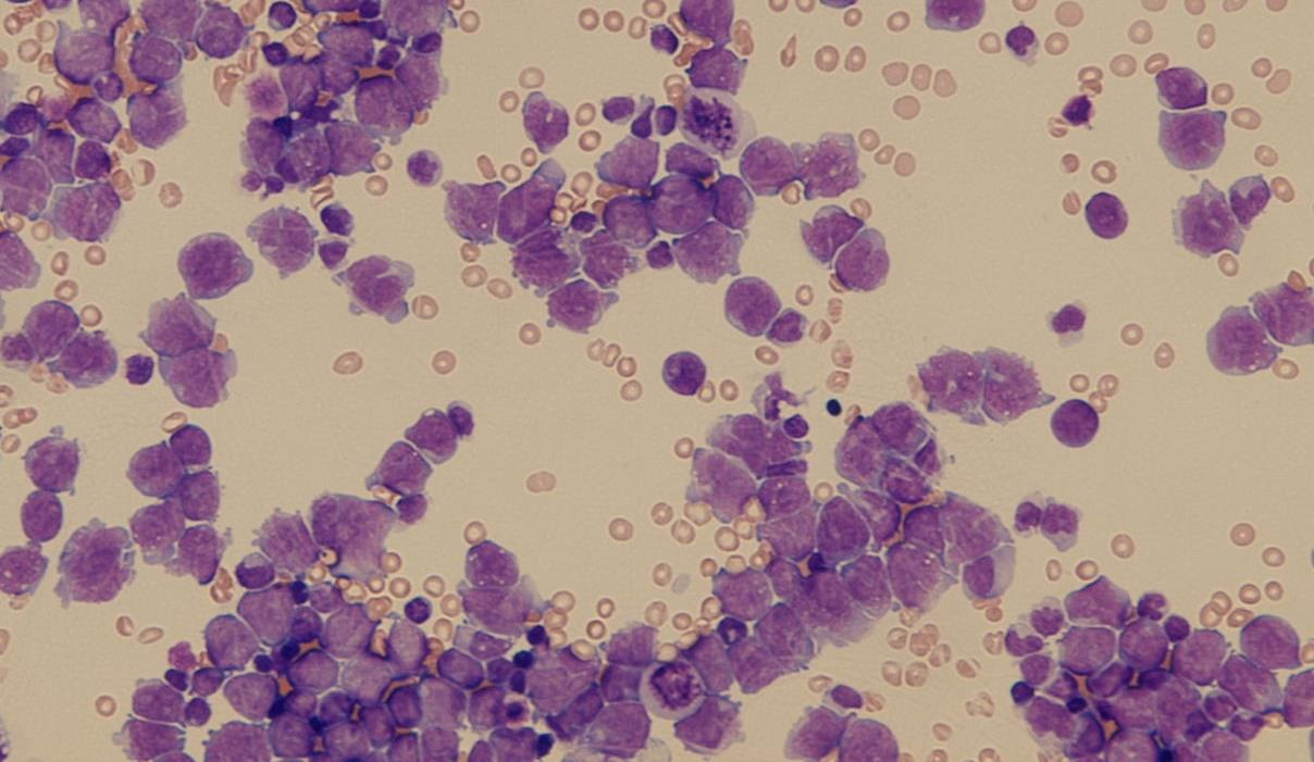 Lymfomová infiltrace- DLBCL ID 3244/2015: Elementy: 128 /ul, Erytrocyty: 2 /ul Cytologický nález s velkými vágně kohezivními elementy s mitózami i atypickými odpovídá ze základního barvení