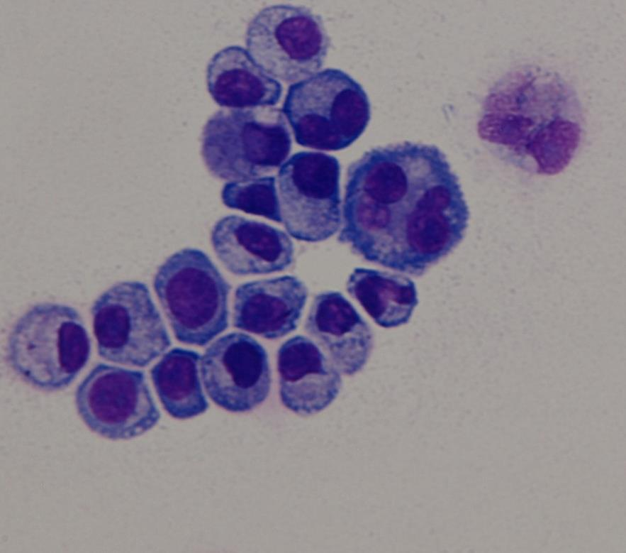 Cytologie- adenoca jícnu ID 3074/2014: Elementy: 85 /ul, Erytrocyty: 23 /ul Klinická epi: pac. se základní dg. adenoca jícnu- nově bolesti C páteře a hlavy, NMR negat. CB CSF: 1.