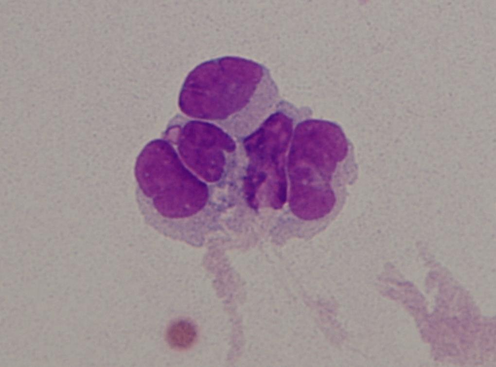 Cytologie- meduloblastom ID 1997/2014: Elementy CSF: 1 /ul, Erytrocyty CSF: 26 /ul Klinická epi: TU IV. komory - histol. meduloblastom anaplastický.