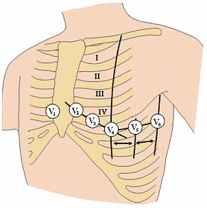 Unipolární hrudní svody Hrudní svody byly zavedeny do elektrokardiografie kvůli tomu, že potenciály v různých místech hrudníku jsou ovlivňovány především nejbližší částí srdce.