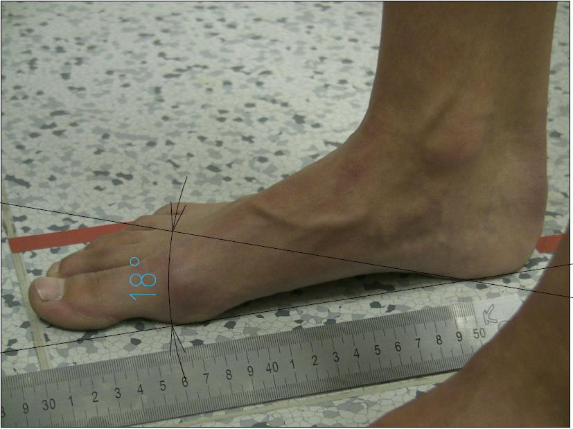 Obr. 29: Foto zboku levá noha před terapií úhel klenby