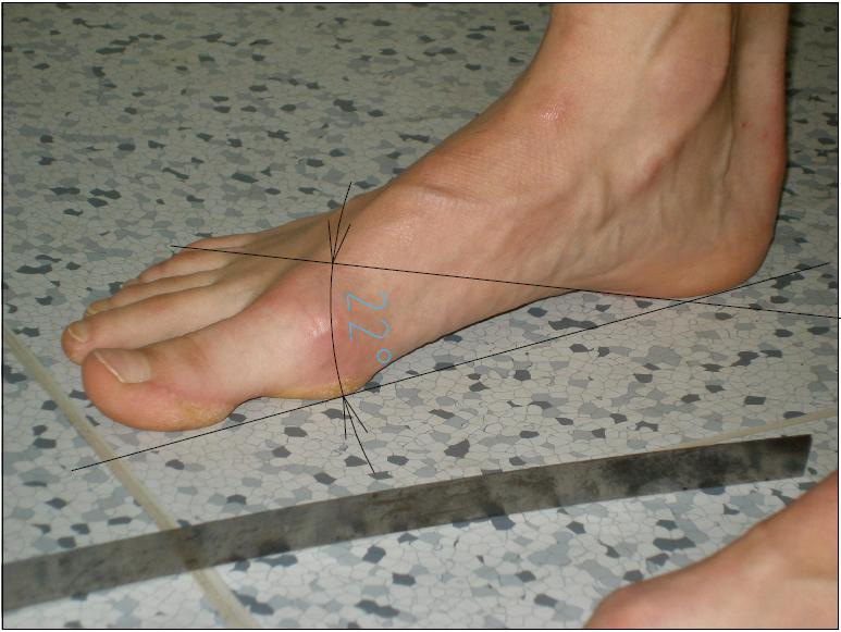 Obr. 31: Foto zboku levá noha po terapii úhel klenby