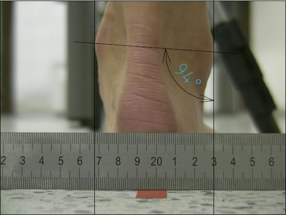 Obr. 33: Foto zezadu levá noha před terapií úhel valgozity kotníku