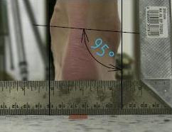 Obr. 35: Foto zezadu levá noha po terapii úhel valgozity kotníku