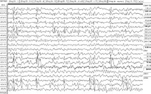 sickým syndromem je meziální temporální epilepsie (MT- LE) spojená s meziální temporální sklerózou (MTS).